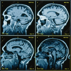 brain scan