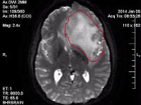 brain cancer image